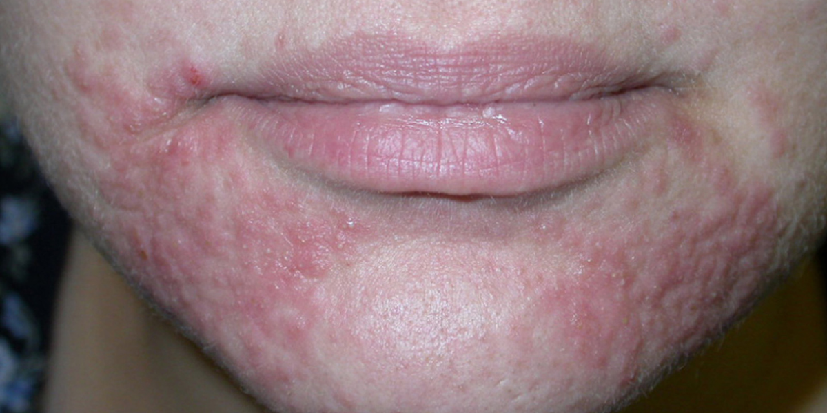 Behandling av perioral dermatitt