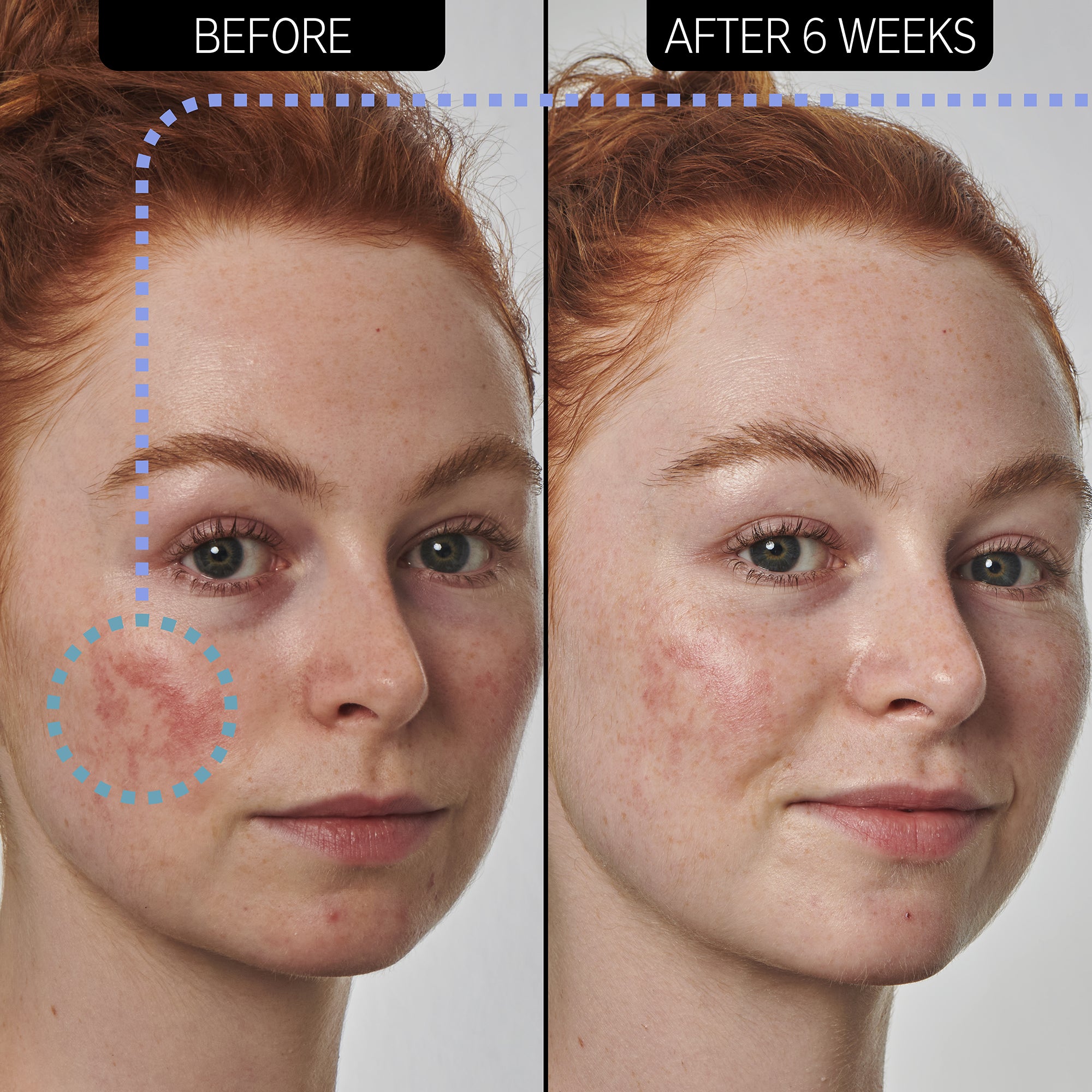 The Inkey List Azelaic Acid 10% Serum 30ml